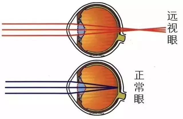 远视眼的定义