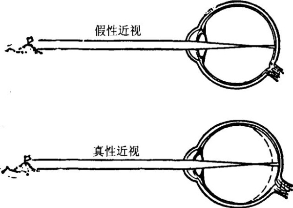 近视真假如何区分