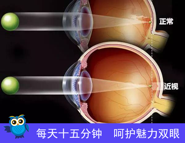 高度近视常见问题解答 石斛手机眼贴
