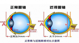 近视600度以上有致盲风险 石斛手机眼贴