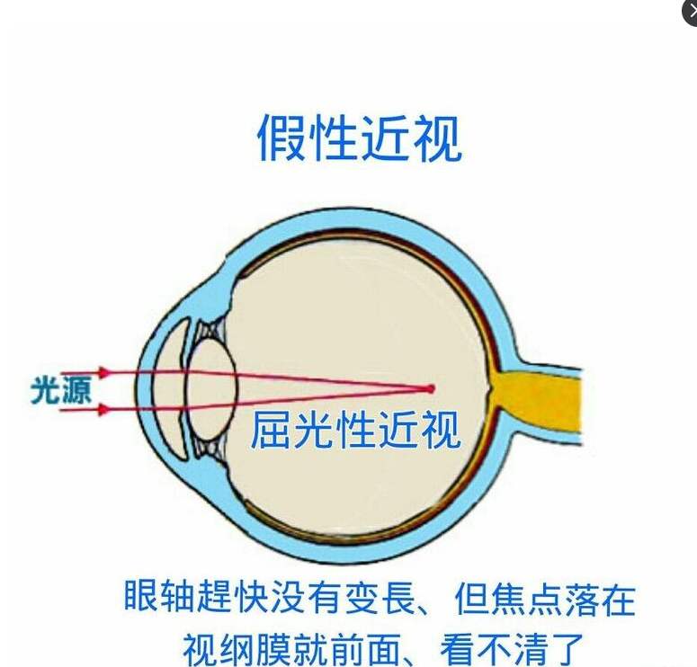 家长应该如何区分真假性近视？石斛手机眼贴