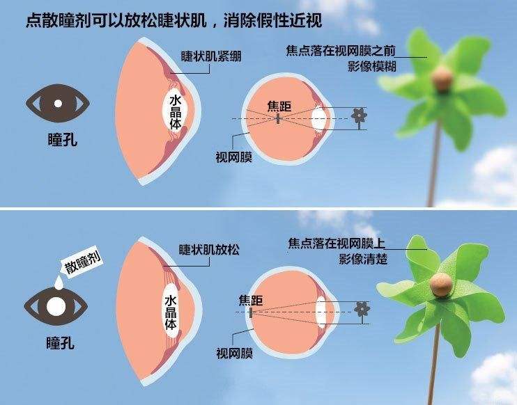 家长应该如何区分真假性近视？石斛手机眼贴